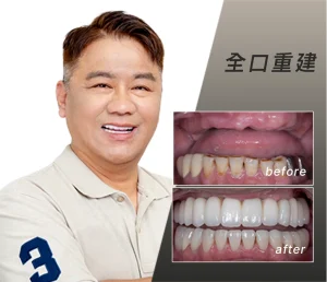 退休後，終於把時間留給自己——何老闆的全口重建故事